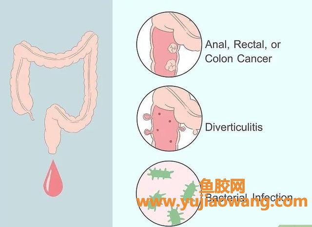 什么是便血 