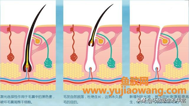 胳膊脱毛 胳膊脱毛会越脱越多吗