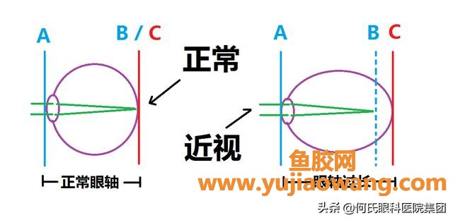 近视会恢复吗 眼近视可以恢复吗